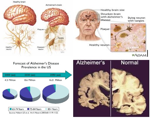 Alzheimers