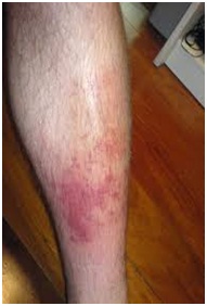 Cellulitis