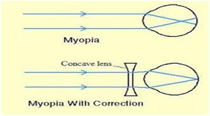 Near-Sightedness